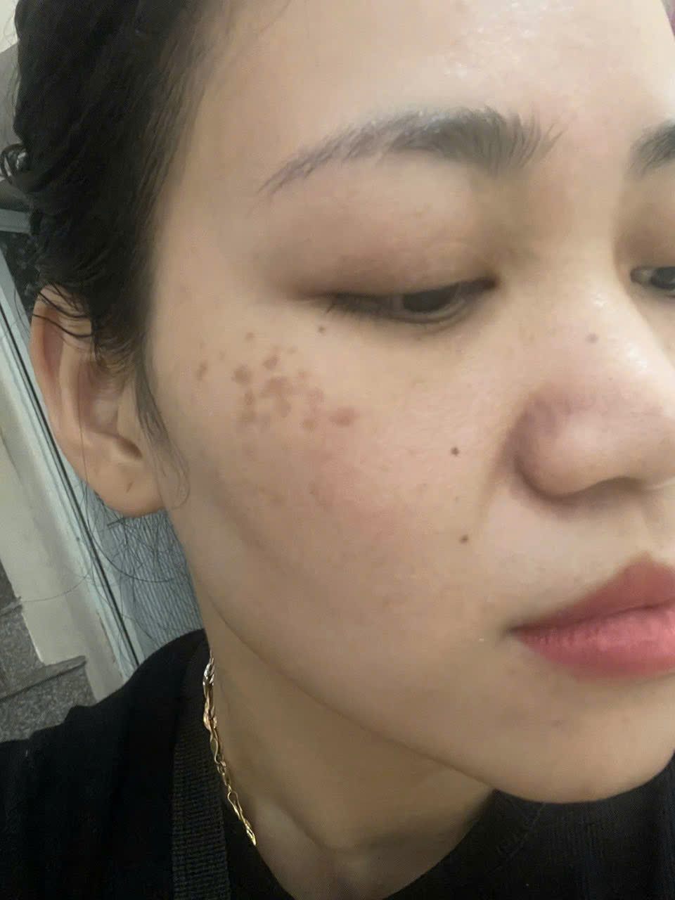 Sai lầm khi điều trị nám