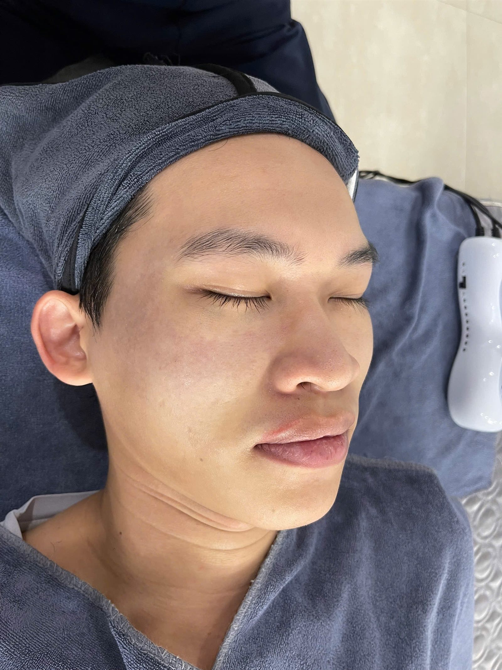 Liệu trình meso tại Sen Ninh Bình