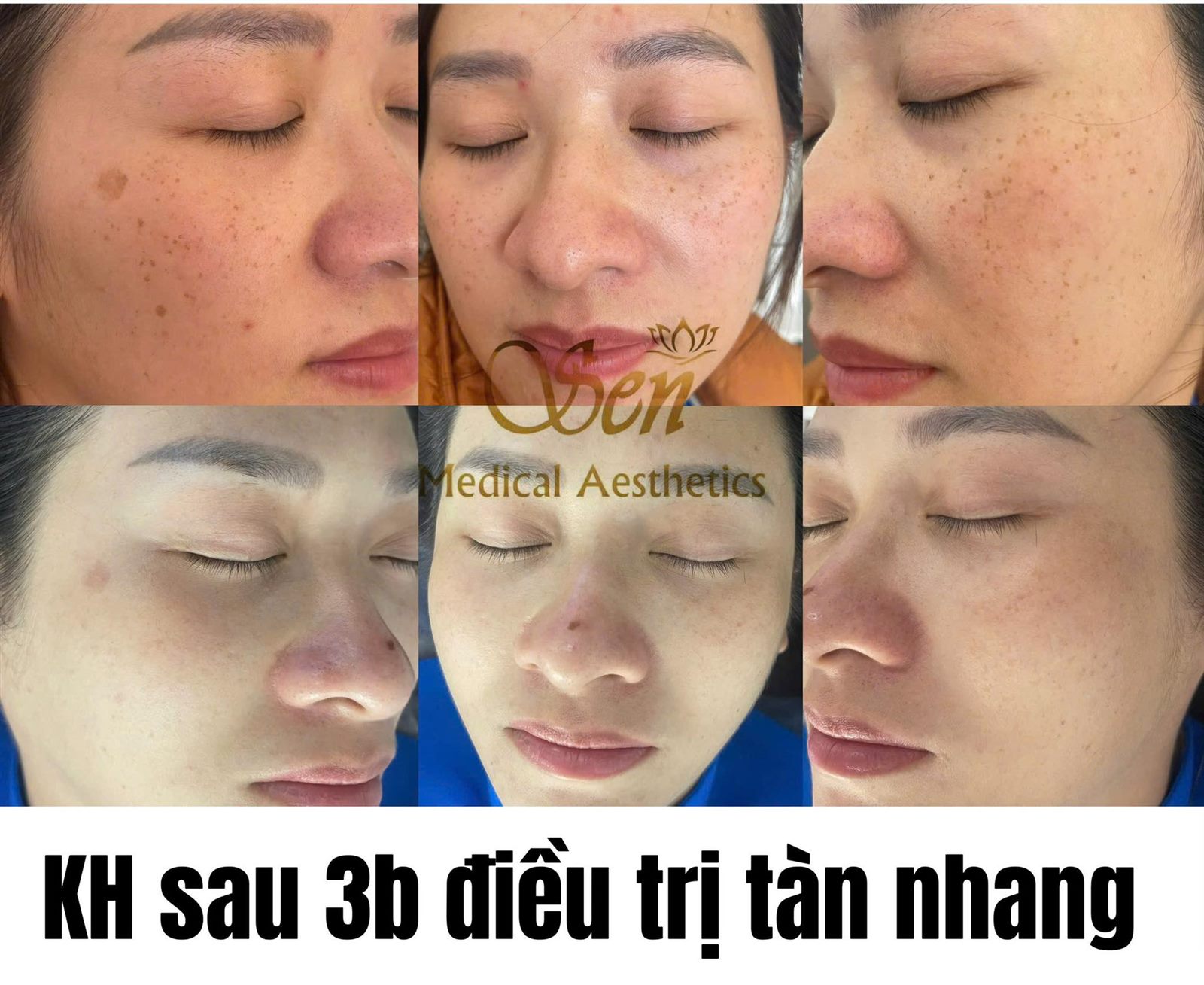Phân biệt nám, tàn nhang, đồi mồi