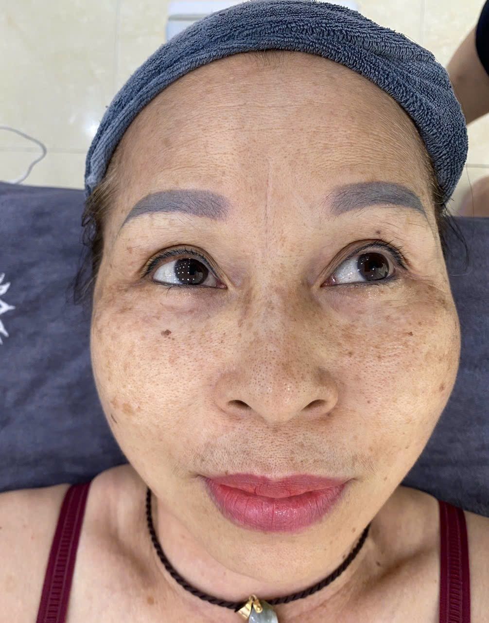Kỳ vọng thực tế khi điều trị nám